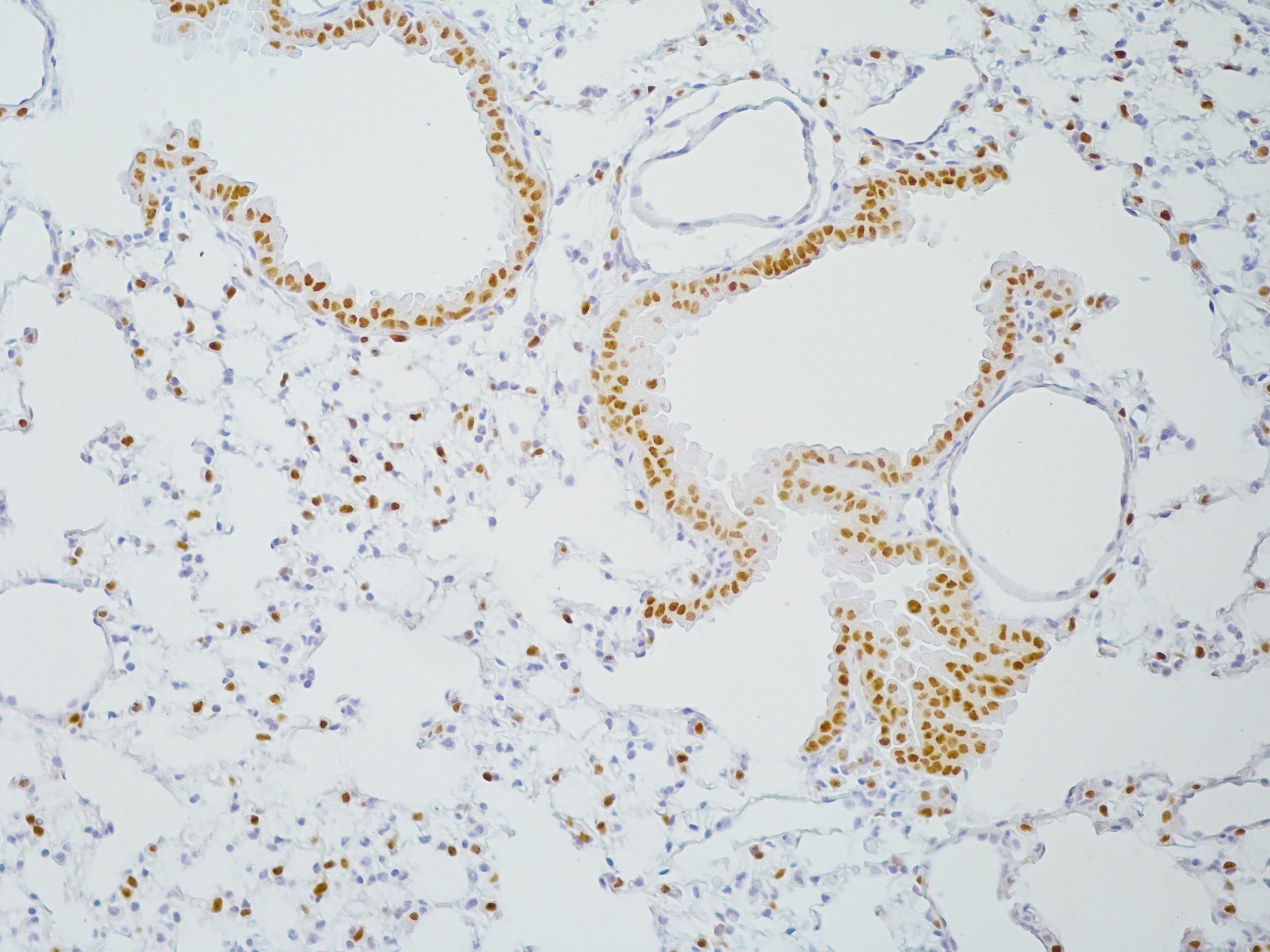 Brightfield microscopy image of lung cancer tissue with immunohistochemistry staining for TTF-1