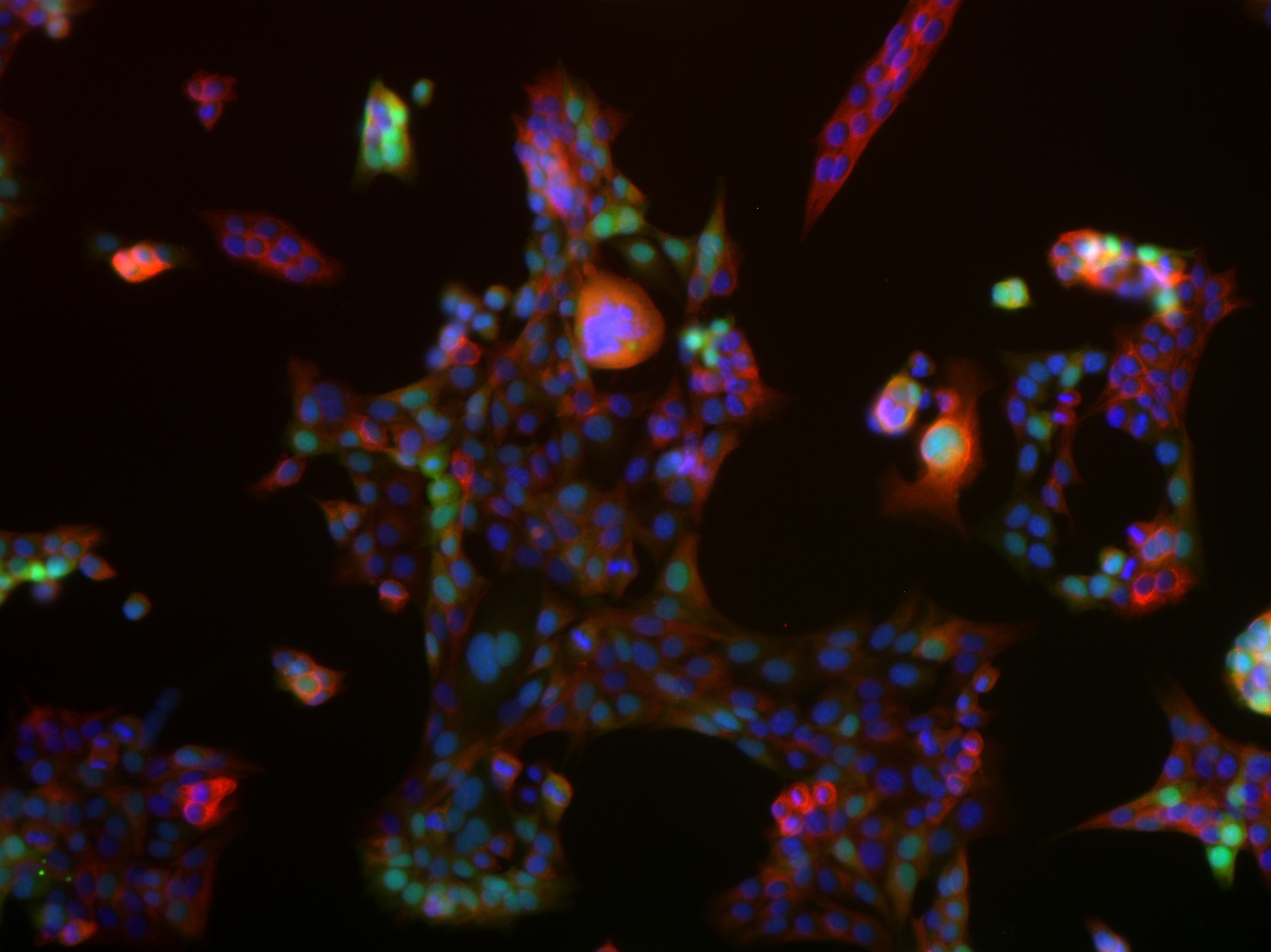 Fluorescence microscopy image of lung cancer cells with green fluorescence protein and immunolabeling for keratin 8 in red