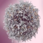 CAR T-Cell Immunotherapy Rids Woman of Tough-to-Treat Lupus